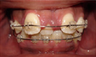 Braces and Extraction
