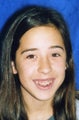 Orthodontic braces with miniscrew anchorage