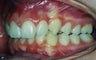 Orthodontic braces to correct a Class II malocclusion