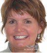 Six Month Smile/ Short term orthodontics