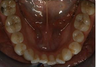 Orthodontic treatment without extraction of teeth