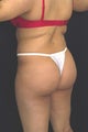 Fat injections to buttocks for Brazilian Butt Lift