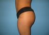 Buttock augmentation (Brazilian buttock lift)