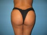 Buttock augmentation (Brazilian buttock lift)