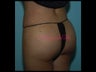Brazilian Butt Lift