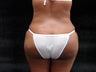 Brazilian Butt Lift