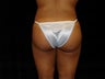 Brazilian Buttocks Lift