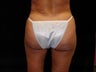 Brazilian Buttocks Lift