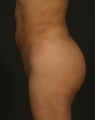 Brazilian Butt Lift
