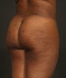 Brazilian Butt Lift
