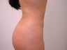Brazilian Butt Lift