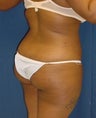Brazilian Butt Lift Fat Injection Buttock Augmentation