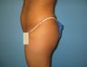 Buttock augmentation (Brazilian buttock lift)