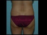 Brazilian Butt Lift
