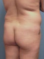 Brazilian Butt Lift