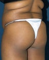 Brazilian Butt Lift (Butt Augmentation)