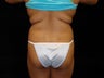 Brazilian Buttocks Lift