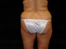 Brazilian Buttocks Lift