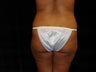 Brazilian Buttocks Lift