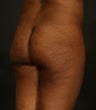 Brazilian Butt Lift