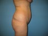 buttock augmentation (Brazilian buttock lift)