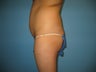 buttock augmentation (Brazilian buttock lift)