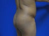 Brazilian Butt Lift and Tummy Tuck - second view