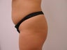 Brazilian Butt Lift