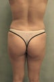 Brazilian Butt Lift