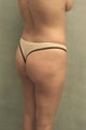 Brazilian Buttock Lift