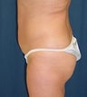 Brazilian Butt Lift