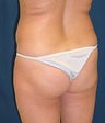 Brazilian Butt Lift