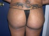 Butt Lift