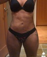 Brazilian Butt lift