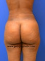 Brazilian Buttock Lift