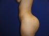 Brazilian Butt Lift
