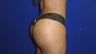 Brazilian Butt Lift