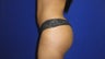 Brazilian Butt Lift
