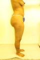 Brazilian Butt Lift