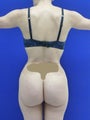 Brazilian butt Lift