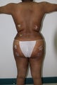 Brazilian Butt Lift