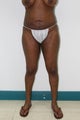 Liposuction