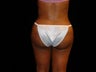 Buttocks Augmentation