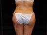 Buttocks Augmentation