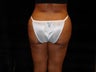 Buttocks Augmentation