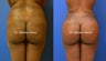 Brazilian Buttock Lift