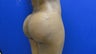 Brazilian Butt Lift/Fat Grafting Buttock Augmentation