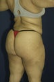 Brazilian Butt Lift surgery (liposuction to multiple areas and fat grafting to buttock)