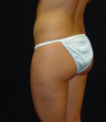 Brazilian Buttocks Lift