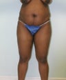 Brazilian butt lift